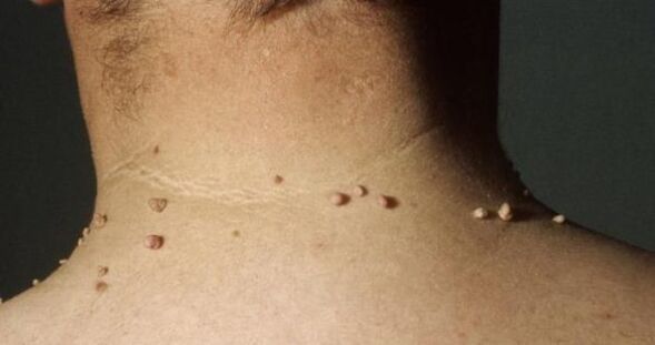 پاپیلوم های کوچک روی گردن