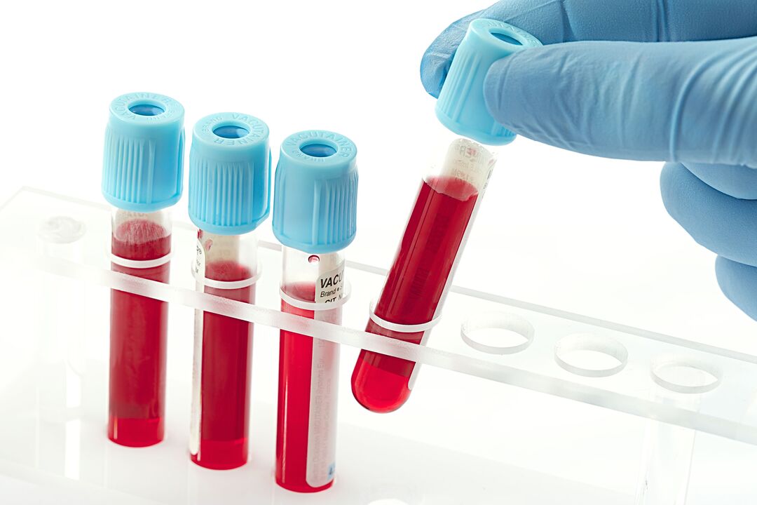 آزمایش خون برای تشخیص ویروس پاپیلومای انسانی